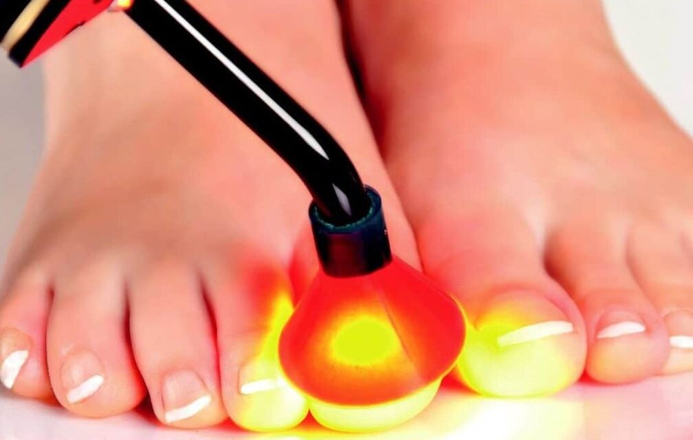Laser treatment of nail plate