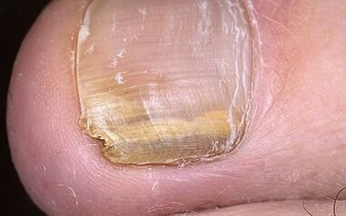 Manifestations of the mushroom in the thumb of the foot
