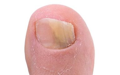 Symptoms of the existence of fungi in the thumb of the foot