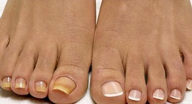 Fleet Mushrooms Treatment Methods