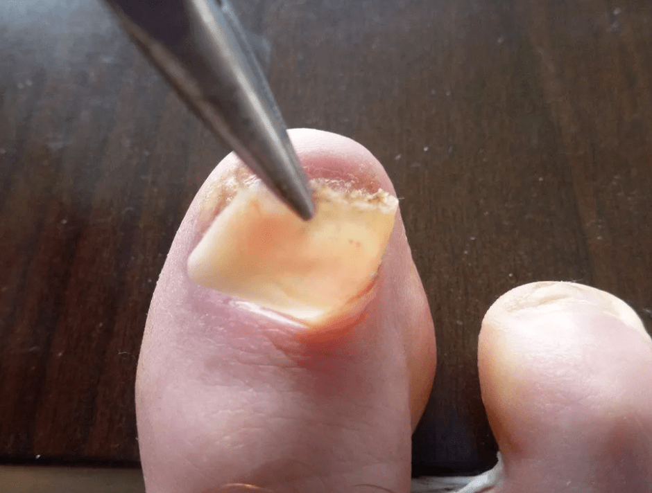 Removal of the plate