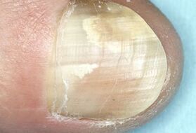 Damage to nail plate due to a fungal infection