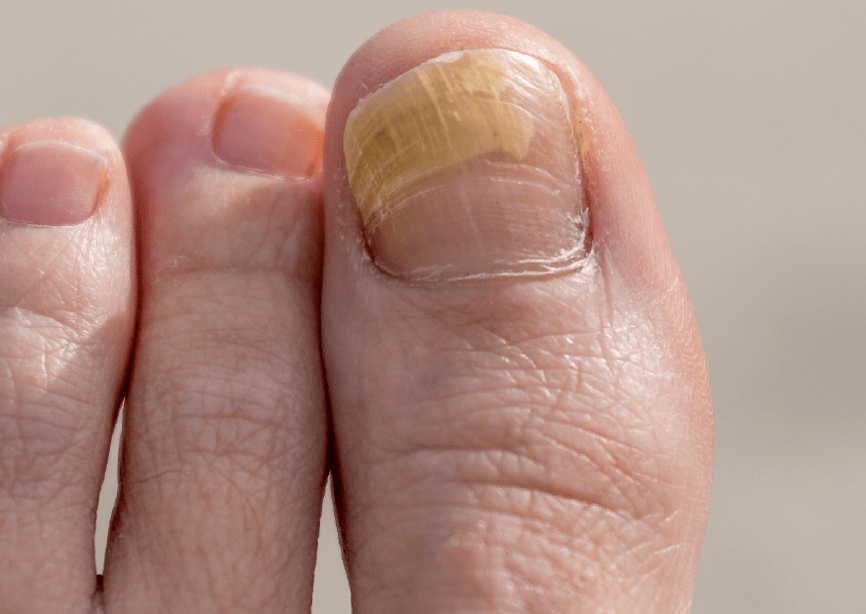 fungus on the nail of the thumb