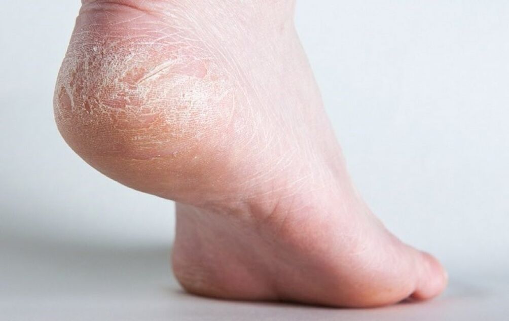 fungus on the skin of the feet